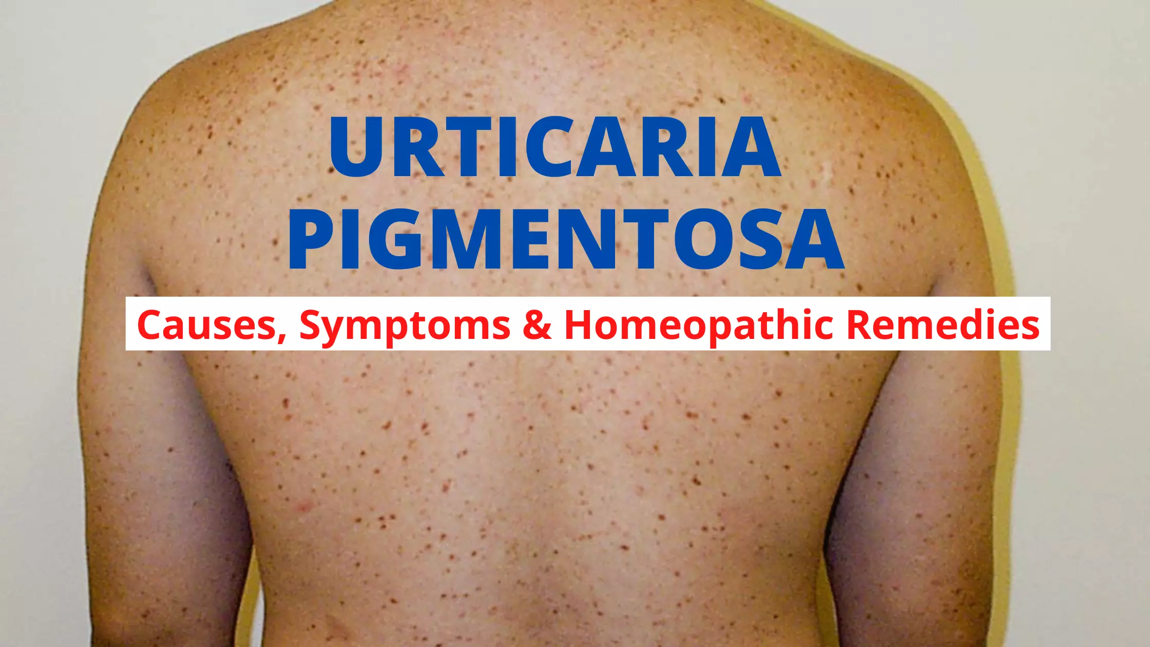 URTICARIA PIGMENTOSA – Causes, Symptoms, Diagnosis Treatment
