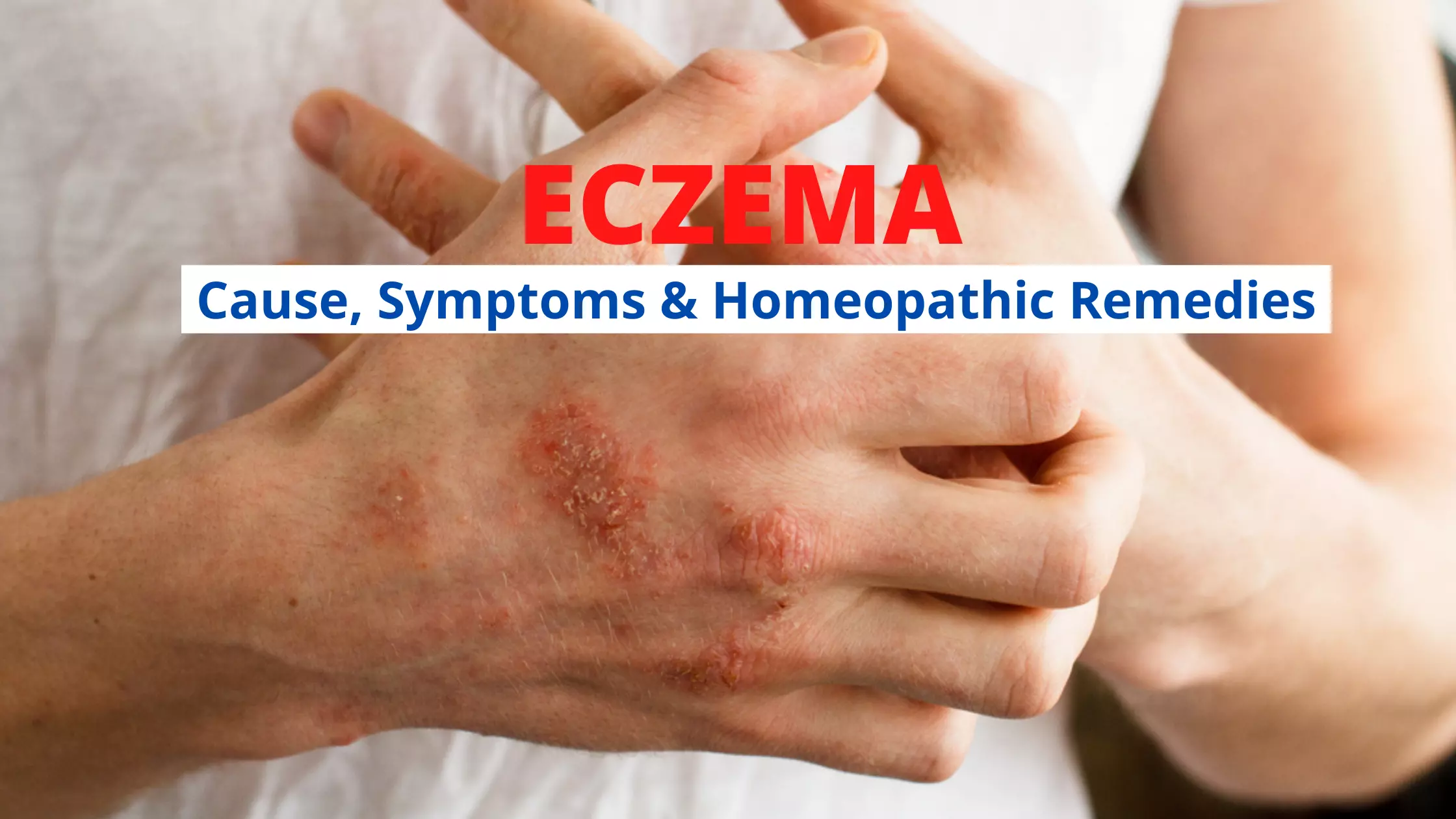 Homeopathy For Eczema – Symptoms, Causes, Types & Medicines