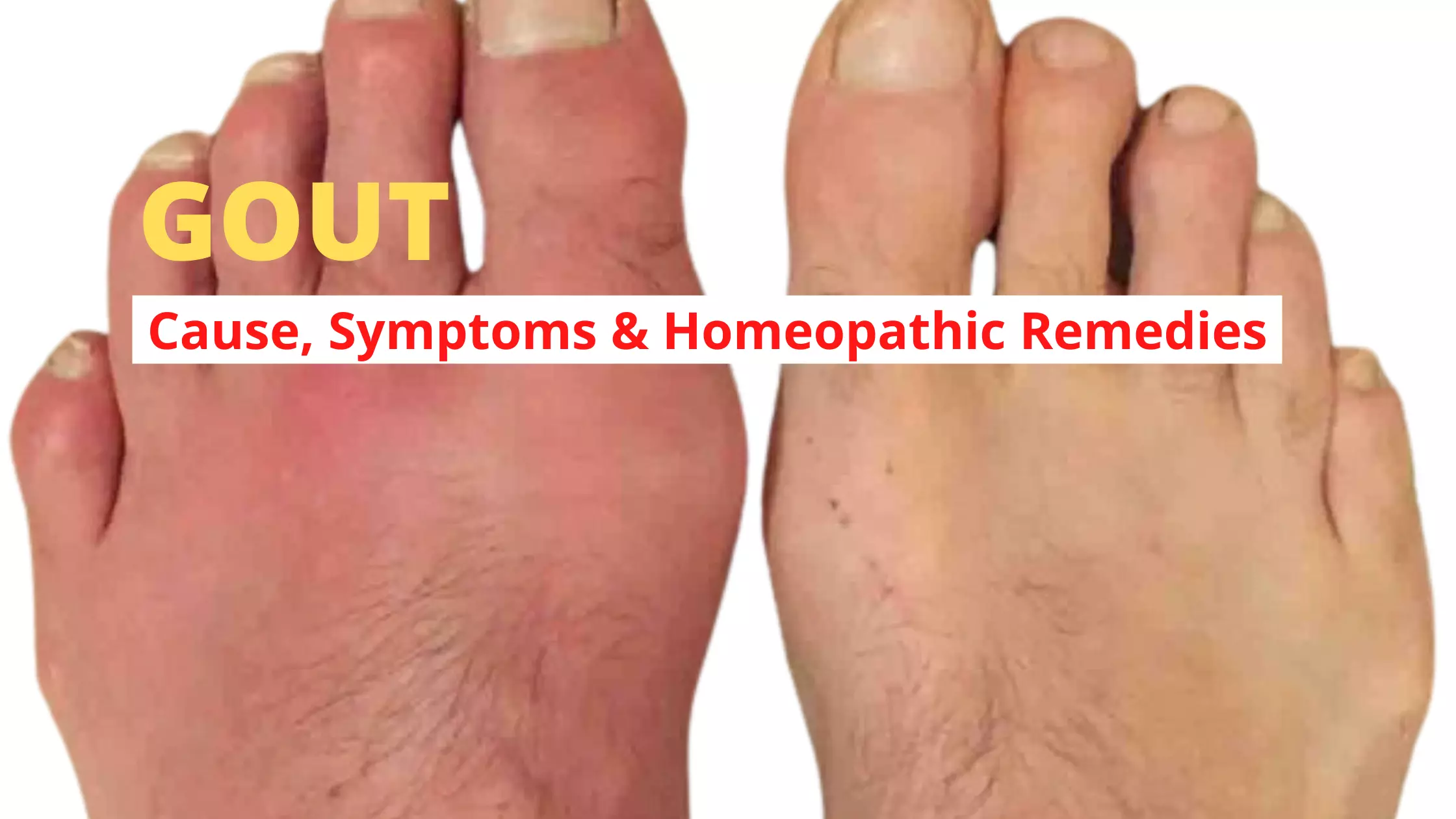 Homeopathy for Gout – Types, Causes, Symptoms Medicines