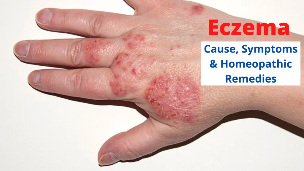 Eczema - Causes, Symptoms and Best Homeopathic Medicines