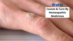 Homeopathy for Warts - Causes, Symptoms, Cure and Medicines