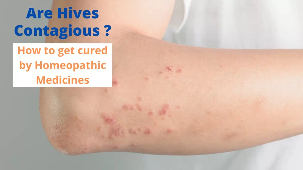 Are hives contagious - Causes, Symptoms and Homeopathy Cure