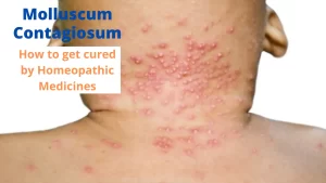 Molluscum Contagiosum- Symptoms and Cure by Homeopathy