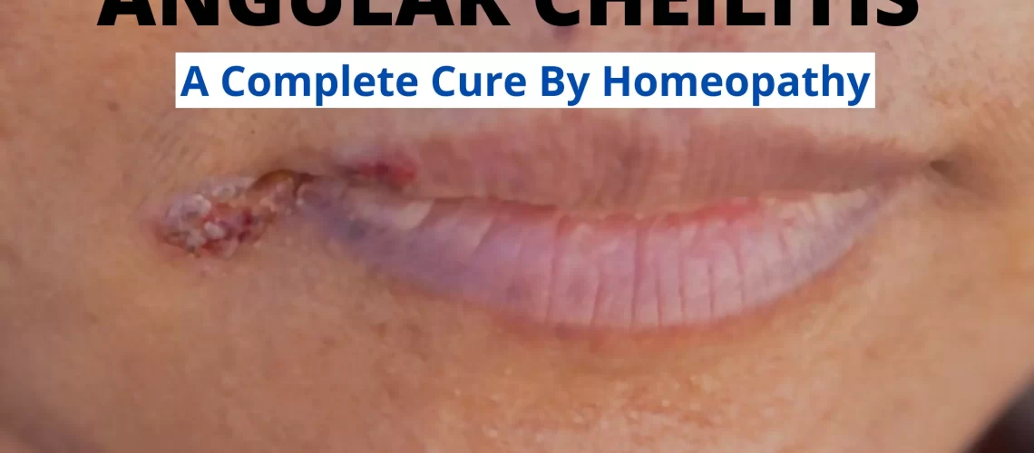 Best-Homeopathic-Remedy-for-Cracks-in-Corner-of-Mouth