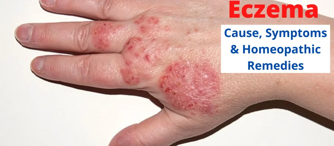 Eczema - Causes, Symptoms and Best Homeopathic Medicines