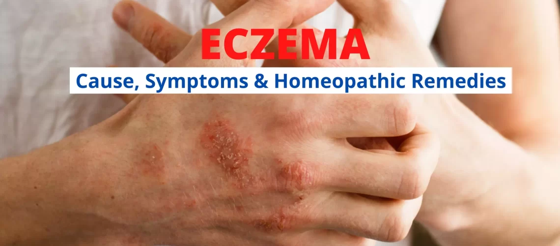 Homeopathy For Eczema – Symptoms, Causes, Types, Treatment Medicines