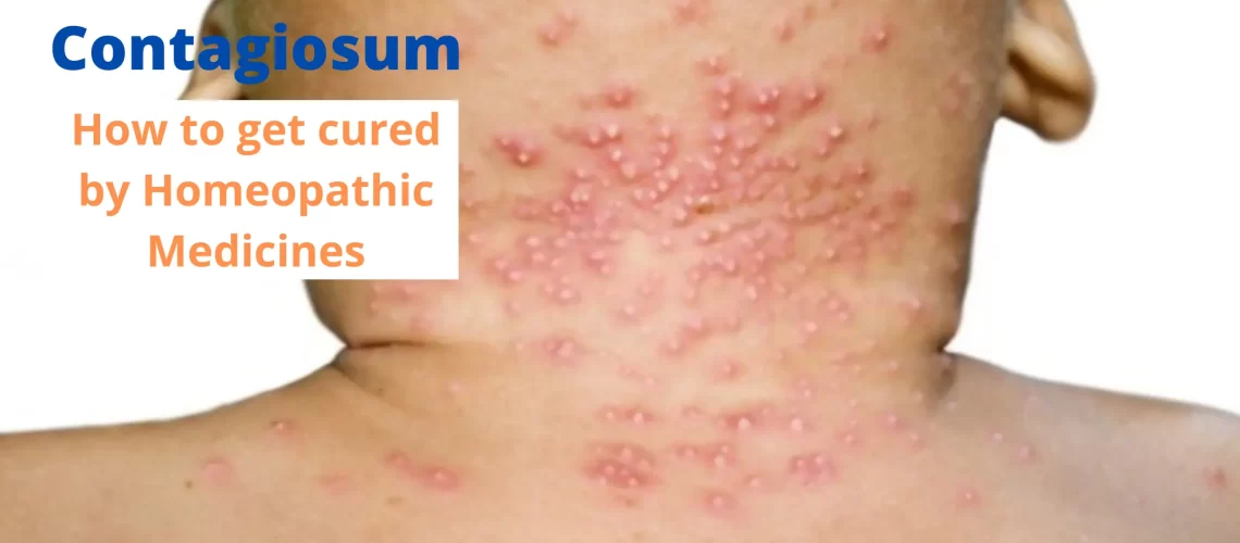 Molluscum Contagiosum- Symptoms and Cure by Homeopathy