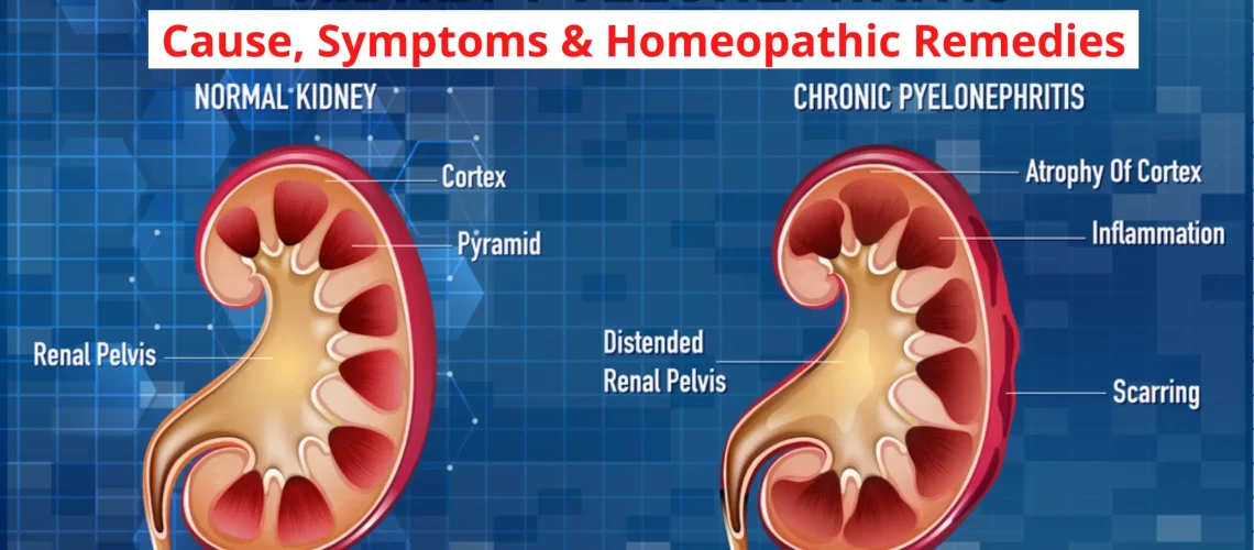 PYELITIS Symptoms, Causes, Diagnosis, Treatment, Homeopathic Medicines