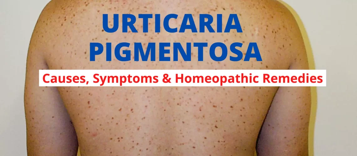 URTICARIA PIGMENTOSA – Causes, Symptoms, Diagnosis Treatment